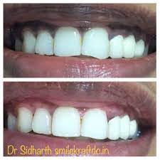 The Normal Color Of Gums Being Pale Pink Abnormally High Amounts Of Melanin Can Cause Dark Spots And Patches On The Cosmetic Dentistry Dental Clinic Dark Gums