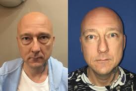 Benjamin Burt, MBBS, FACS, Oculoplastic Surgeon, Specialist in  Ophthalmology