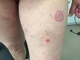 Image result for koebner phenomenon psoriasis