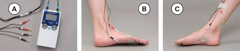 Tasci Transcutaneous Tibial Nerve Stimulation In Patients With Acute Spinal Cord Injury To Prevent Neurogenic Detrusor Overactivity Protocol For A Nationwide Randomised Sham Controlled Double Blind Clinical Trial Bmj Open