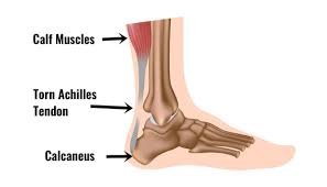 Maybe you would like to learn more about one of these? Achilles Tendon Rupture Symptoms Causes Treatment