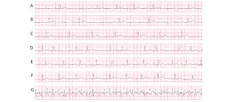 Image result for Lyme Carditis