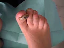Image result for Onychogryphosis feet