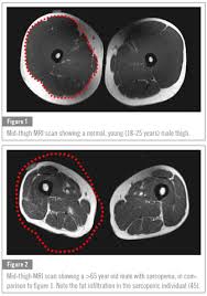It is characterized by the degenerative loss of skeletal muscle mass, quality, and strength. Sarcopenia Causes And Treatments