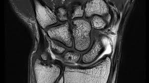 Wer ist besonders häufig betroffen? Mri Handgelenk Und Hand Mri Zurich