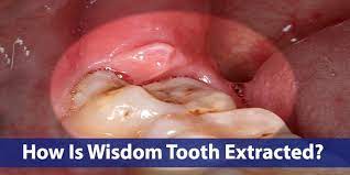 How Is Wisdom Tooth Extracted Thornhill Dentist Thornhill Dentist Near Me Thornhill Dental Clinic