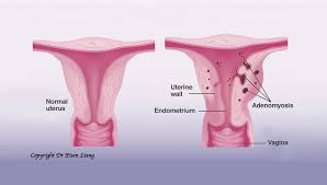 Adenomyosis and endometriosis are all caused by endometriosis growth. Adenomyosis An Overlooked Suspect For Heavy Painful Periods Sydney Fibroid Clinic
