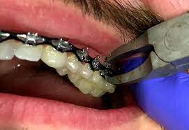 Today on the #bracesbreakdown, dr. How Are Braces Removed Premier Orthodontics
