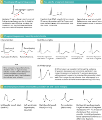 Maybe you would like to learn more about one of these? St Segment Depression In Myocardial Ischemia And Differential Diagnoses Ecg Echo