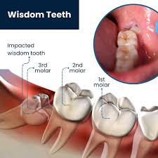 Image result for Tooth Extraction