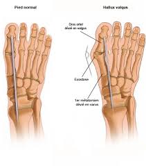 Image result for Hallux Varus