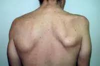 Image result for Winged Scapula