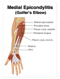 Elbow sprains are common in athletes who throw, use racquets,. Tennis Elbow Golfer S Pain Acupuncture Treatment Nashik