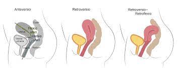 子宫后位Retroverted Uterus: 最新的百科全书、新闻、评论和研究