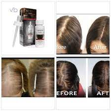 Pin By Maegan Pena On Sally S Help In 2021 Hair Regrowth Treatments Hair Loss Treatment Help Hair Loss