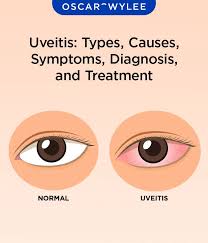 Image result for Uveitis