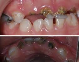 Baby Bottle Tooth Decay Or Early Childhood Caries Eec Is Most Common In The Upper Front Teeth But The Back Teet Baby Bottle Tooth Decay Dental Dental Help