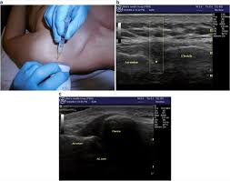 Image result for Subacromial Space Injection