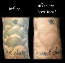 .artificial joints or implanted electrodes, dental posts, body piercings or even so called permanent makeup, eyeliner or eyebrows that are tattooed on. Laser Tattoo Removal