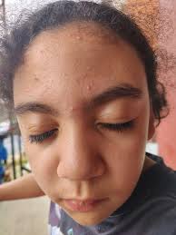 I am seeking advice regarding my 13-year-old daughter, who has developed  tiny bumps