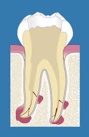 Everything you need to know about root canals Root Canal Treatment Praxis Am Kureck