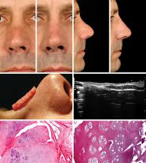 The Diced Cartilage Glue Graft for Nasal Augmentation