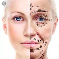 Plasma Fibroblast Dundee