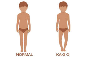 Di dalam masa perkembangannya, bentuk tulang dapat berubah atau mengalami kelainan apabila ada gangguan yang dibawa sejak lahir. Normalkah Anak Miliki Kaki O Dan Bisakah Sembuh Ini Penjelasannya Semua Halaman Nakita