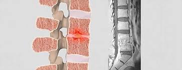 Image result for Spinal Infection