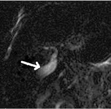 Introduction • biliary atresia is characterized by obliteration or discontinuity of the extrahepatic biliary system, resulting in obstruction to bile flow. Comparison Of Mrcp With Intraoperative Cholangiography In Paediatric Choledochal Cyst And Biliary Atresia