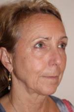 Face & Neck Lift Before and After Photos