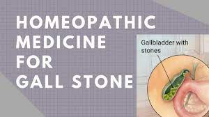 Homeopathic Medicine For Gallbladder Stone How To Get Rid Of Gallstone Homeopathic Medicine Homeopathic Gallbladder Stones