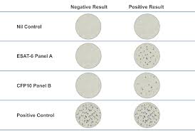 People from countries where tb is common may have. Latent Tuberculosis Infection Core Concepts