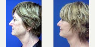 Don Fontana, MD Reviews, Before and After Photos, Answers