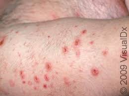 Image result for folliculitis symptoms