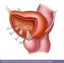 Bladder cancer is one of the more common cancers. Bladder Cancer Types Symptoms Diagnosis Treatment Md Anderson Cancer Center