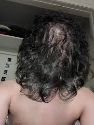 Buzz cut hairstyles for balding men. Baby Fine Curls I Always Look Bald Any Product Or Supplement Recs