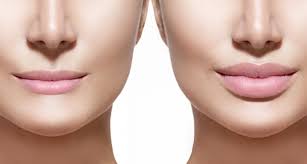 Recovery after juvederm lip injections. Lip Injections Is One Syringe Too Much Midwest Laser Centre