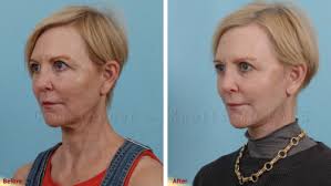 Facelift Photo Gallery