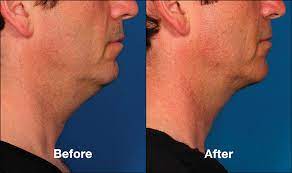 A double chin can be hereditary in some cases or can be caused by weight fluctuations over a person's lifetime. Kybella Boston Plastic Surgery