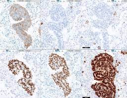 This moab is directed against a cell surface glycoprotein reported to be present in most epithelial cells and epithelial tumors but not in mesothelial cells. Pathology Outlines Berep4 Epcam