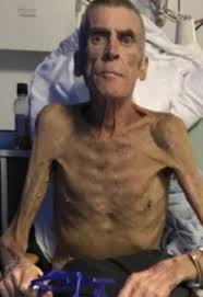 In this confined and gloomy space the newspaper's correspondent and the doctor found a man suffering from fever and an emaciated child ill with dysentery. Emaciated Man Deemed Fit For Work Despite Weighing Six Stone Dies After Health Problems Daily Star