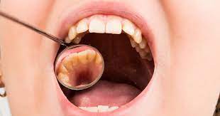 According to the timeline for permanent teeth emergence, the years between 10 and 12 will see the eruption of a number of teeth. Permanent Teeth Timeline Mint Hill Dentistry