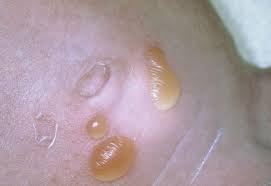 Image result for sores on the head in children