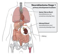 This article is more than 4 years old. Childhood Neuroblastoma Cancer Causes Risk Factors And Prevention Acco
