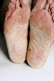 Dermatitis De Las Manos Y Los Pies Trastornos Dermatologicos Manual Merck Version Para Profesionales