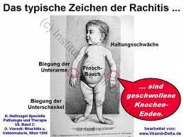 Pdf Download 35 Seiten Wie Kinder Unter Einem Vitamin D Mangel Leiden Die Haufigste Hormonelle Storung Von 0 18 Jahren Vitamin D Service