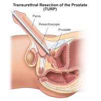 Excess Prostate Tissue Is Removed During A Turp To Let Urine Flow Freely Through The Urethra Prostate Enlarged Prostate Nursing School Notes
