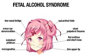 Epicanthal folds/ brushfield spots large tongue/flat nasal bridge. Fetal Alcohol Syndrome Doki Doki Literature Club Know Your Meme