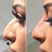 Results last up to six months.perlane: Dermal Nose Fillers Provided In Kent And Nearby Areas